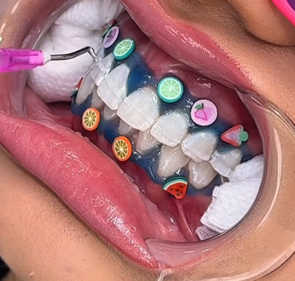 Decoración barrera gingival